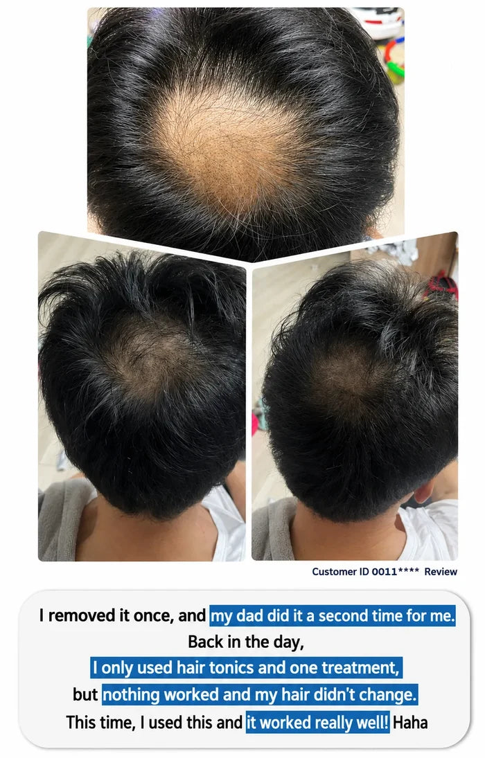 A collage of three close-up views of a person's hairline and crown showing significant hair loss/thinning, with a review text box below describing hair care struggles and relief after using a product.