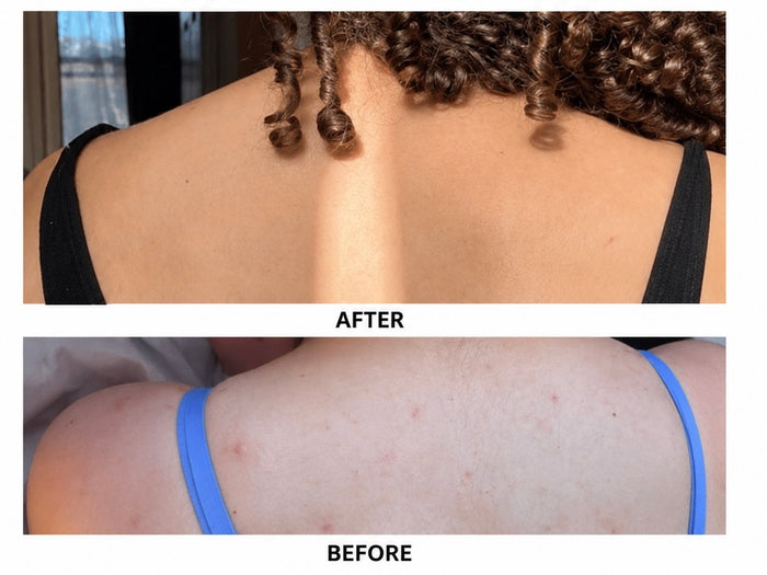 Dahar bundle| Back acne bundle