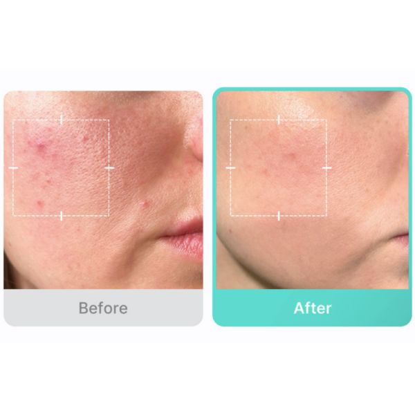 MEDICUBE Azelaic Acid  16 BB Calming Serum 16% Azelaic Acid سيروم الازليك اسد من ميديكيوب